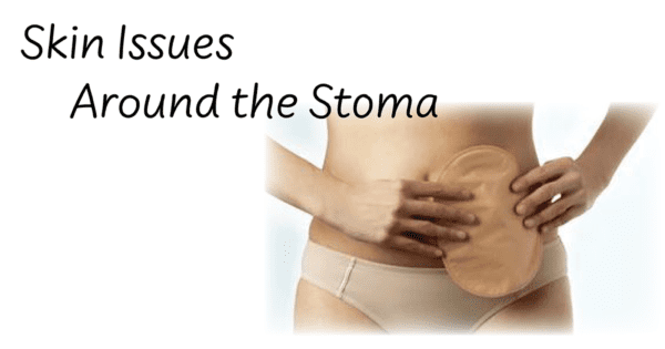 What will my stoma be like?