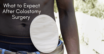 A black man with a colostomy pouch for information on What to Expect After Colostomy Surgery